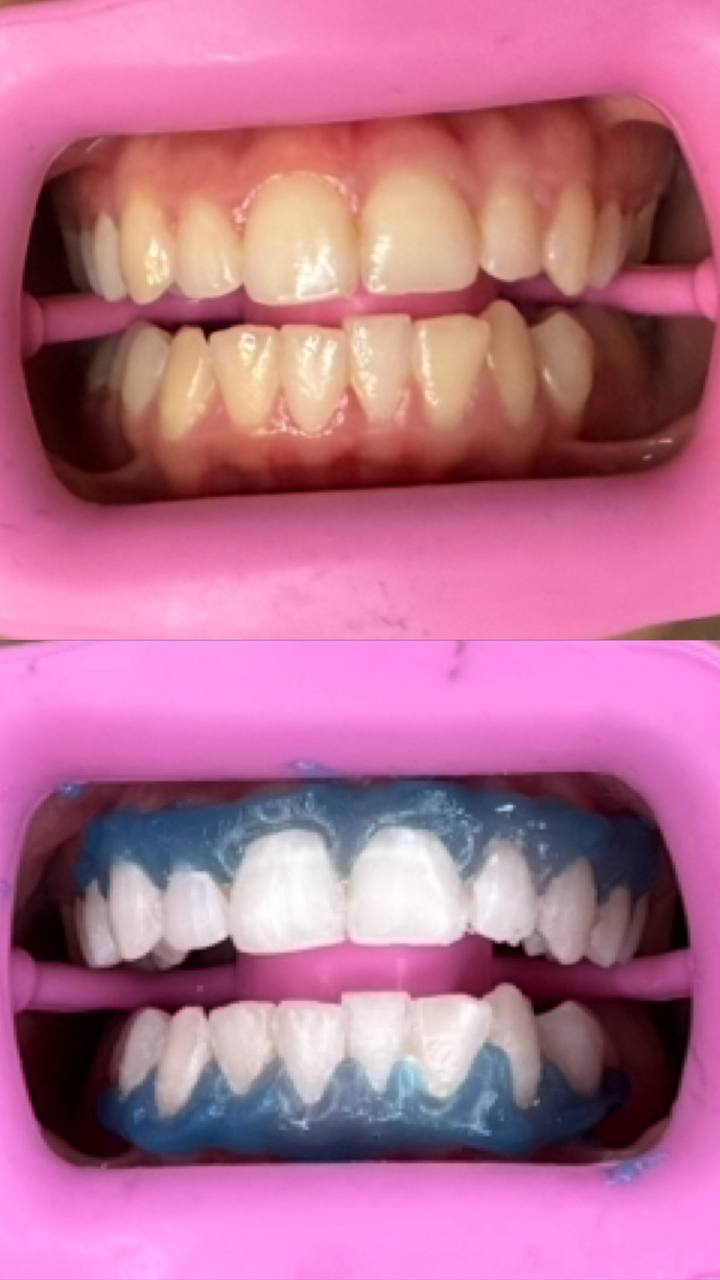 Blanchiment dentaire avant après Toulouse - Ysglow